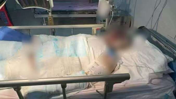 父子在哈尔滨一亲戚公司上班遇爆炸全身烧伤，治疗花费近百万公司拒赔偿？亲戚回应