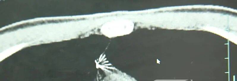 17岁小伙参军体检发现胸腔内有根5cm缝衣针，父母回忆或是1岁时扎入，取出时已锈迹斑斑